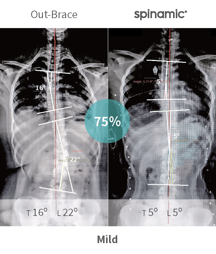 Mild scoliosis Cobb angle correction case — 75% improvement