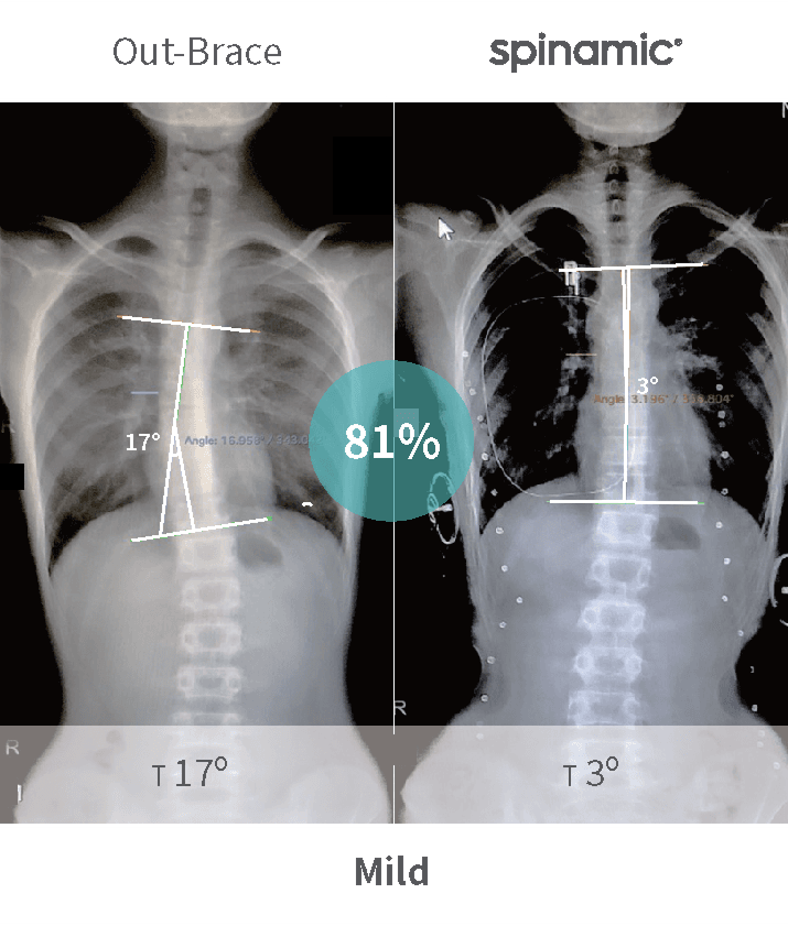 Mild scoliosis Cobb angle correction case — 81% improvement