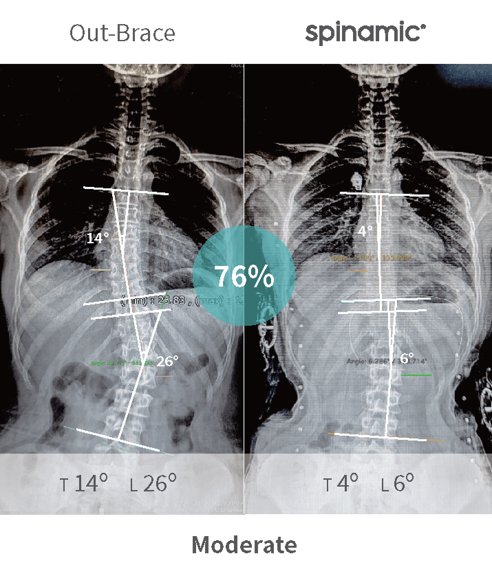 Moderate scoliosis Cobb angle correction case — 76% improvement