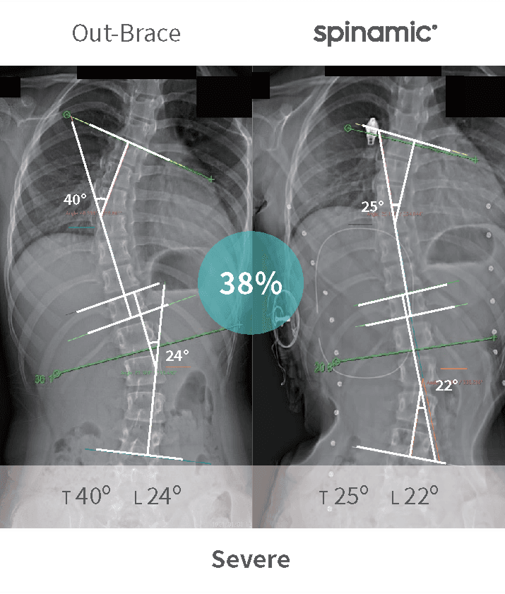 Severe scoliosis Cobb angle correction case — 38% improvement